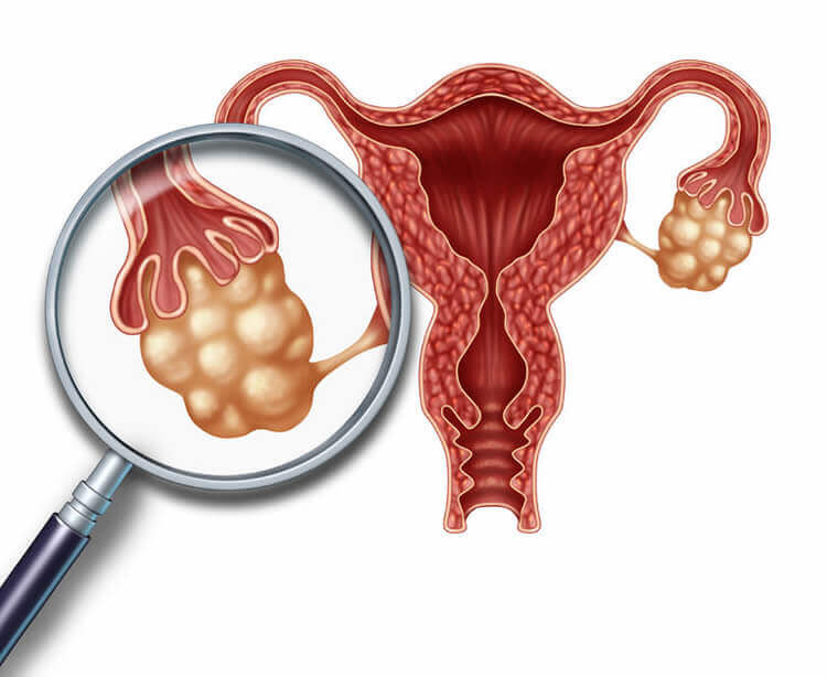 EHH Connection between Polycystic Ovary Syndrome (PCOS) and Weight